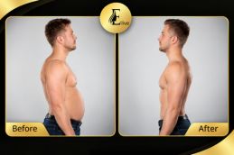 Before and after result Fat-reduction Injection Abu Dhabi