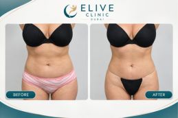 Before and after result Fat-reduction Injection