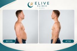 Before and after result Fat-reduction Injections in Dubai Abu Dhabi