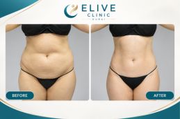 Before and after result Fat-reduction Injections in Dubai