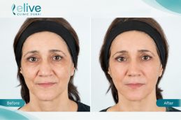Before and after result of Redensity 2 Filler Injection Abu Dhabi