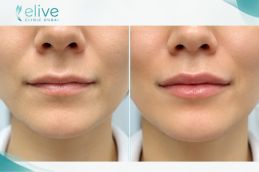 Before and after result of Redensity 2 Filler Injections Abu Dhabi