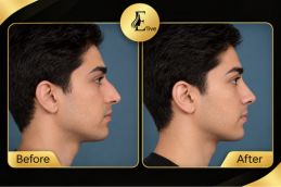 Before and after results Fat-reduction Injections in Dubai