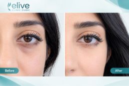 Before and after results of Redensity 2 Filler Injections in Abu Dhabi