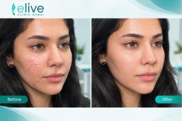 Before and after results of Redensity 2 Filler Injections in Dubai
