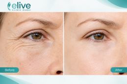 Before and after results of Redensity 2 Filler Injections in Dubai