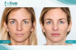 Before and after results of Redensity 2 Filler Injections