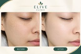 Glutathione Injection before and afTer RESULT IN Dubai & ABu Dhabi