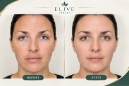 Glutathione Injection before and afTer RESULTS ABu Dhabi