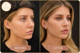 Nefertiti Lift Treatment results in Dubai
