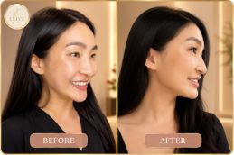 Nefertiti Lift Treatment results in Dubai & Abu Dhabi