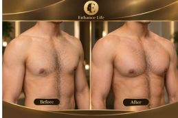 Result of Pectorial Implant Surgery in Dubai