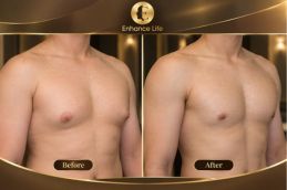 Results of Areola Reduction Surgery in Dubai