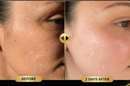 Xeomin Treatment in Dubai & Abu Dhabi before and after result (1)