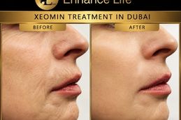 Xeomin Treatment in Dubai before and after