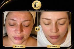 Xeomin Treatment in Dubai before and after result