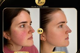 Xeomin in Dubai before and after result