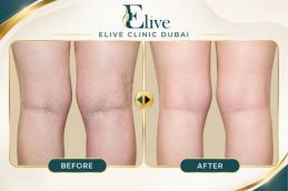 After PRP knee injection treatment in Dubai at Elive Clinic