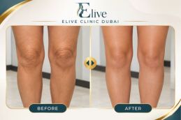 After platelet-rich plasma knee treatment in Dubai