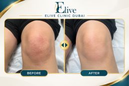 After PRP treatment for knee osteoarthritis in Dubai