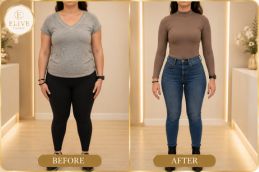 Before Semaglutide weight loss treatment in Dubai