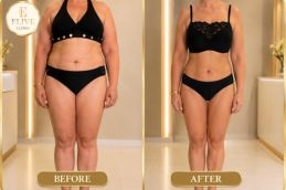 Before weight loss injection treatment in Dubai at Elive Clinic