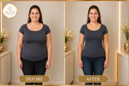 Before Tirzepatide weight loss treatment in Dubai