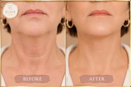 before and after of Nefertiti Lift Treatment results in Dubai & Abu Dhabi
