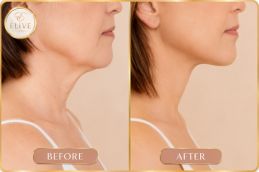 before and after of Nefertiti Lift Treatment results in Dubai UAE