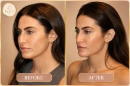 before and after of Nefertiti Lift Treatment results in UAE