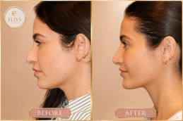 before and after of Nefertiti Lift results in UAE