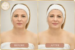 before and after of scarless breast augmentation results in UAE
