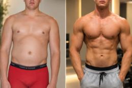 before and after result Macrolane Injections in Dubai