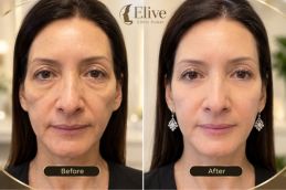 before and after result Sculptra Filler in Dubai