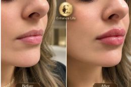 before and after result of Lip Aumentation in Dubai & Abu Dhabi