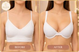 before and after result of scarless breast augmentation Dubai