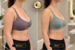 before and after results Breast Lump Treatment in Dubai