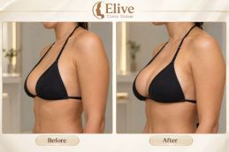 before and after results Macrolane Injections in Dubai