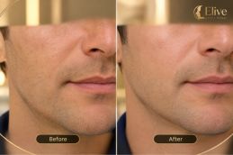 before and after results Sculptra Filler Dubai