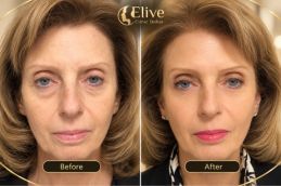 before and after results Sculptra Fillers in Dubai