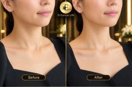 before and after results of Hyaluronic Injection Dubai
