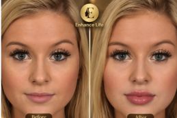 before and after results of Lip Aumentation in Dubai & Abu Dhabi