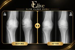 Before PRP knee injection treatment in Dubai at Elive Clinic