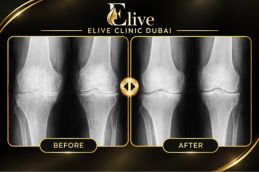 Before platelet-rich plasma knee treatment in Dubai