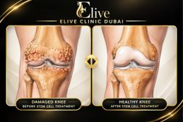 Before PRP treatment for knee osteoarthritis in Dubai