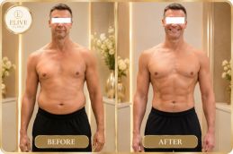 After Semaglutide weight loss treatment in Dubai