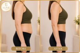 After weight loss injection treatment in Dubai at Elive Clinic