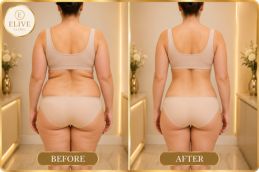 After Tirzepatide weight loss treatment in Dubai
