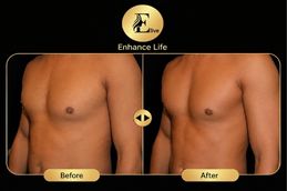 inverted niple surgery before and after