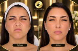jawline fillers injections before and after in Dubai